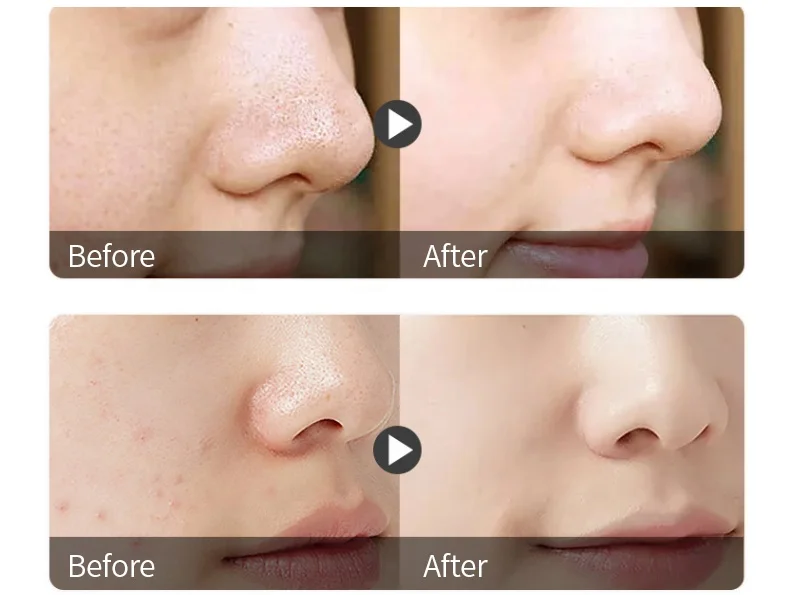 Индивидуальная фирменная лента для удаления черных точек на носу, уход за кожей, глубокое очищение, сужение пор, полоски для очистки носа