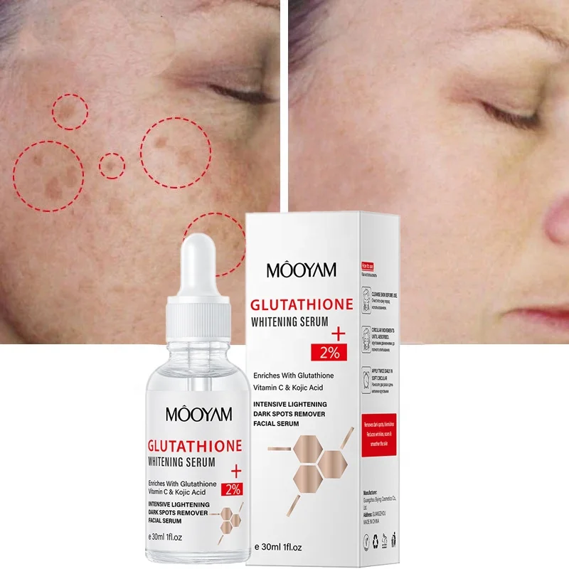 can glutathione remove melasma Hyperpigmentation Treatment with Glutathione