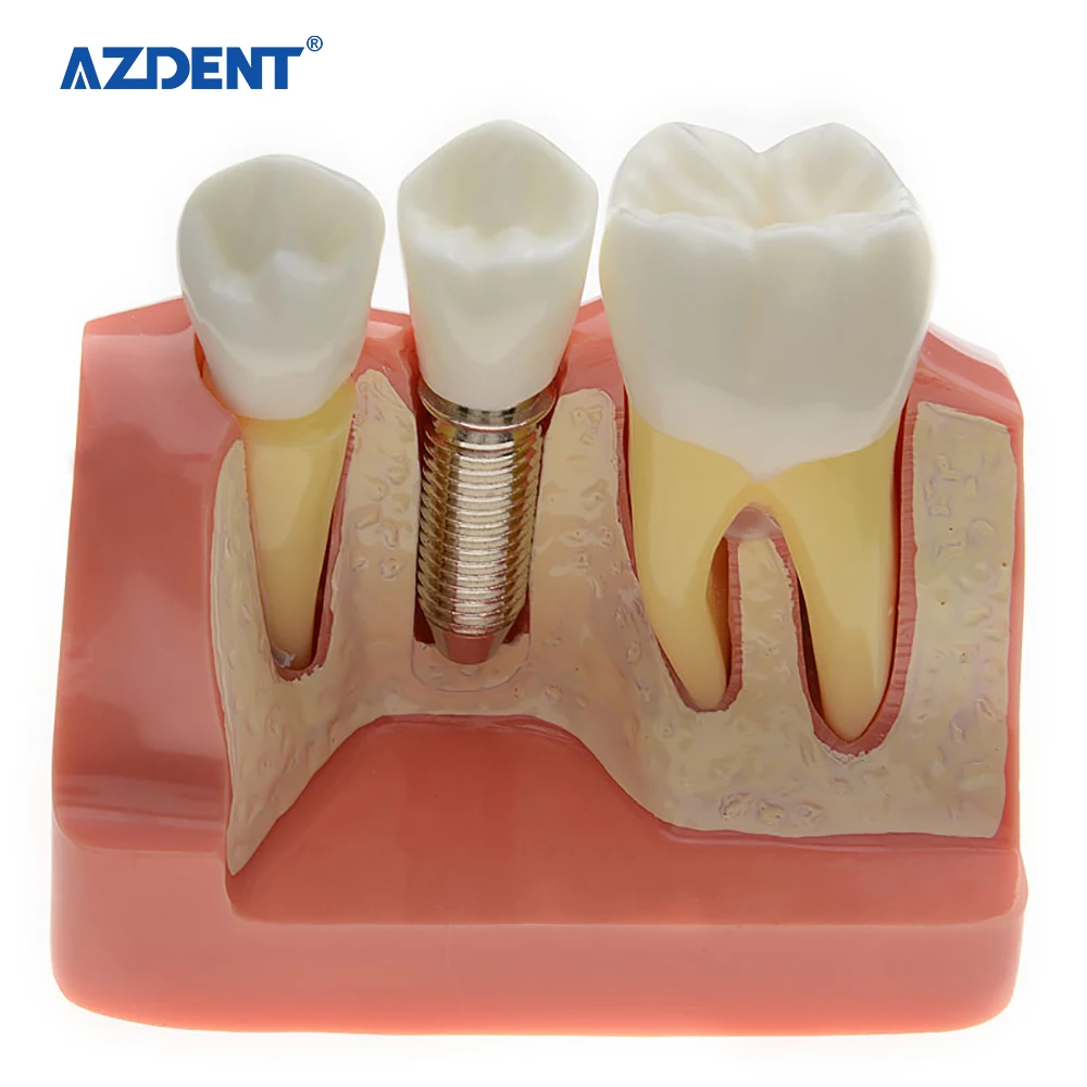 стоматология мост зубов