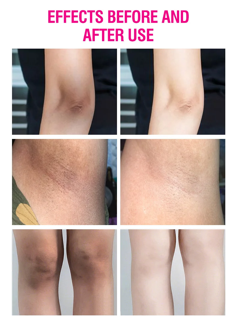 Aichun Beauty 3 Days Whitening Dark Spot Cream Face Body Armpit Underarm Whitening Cream for Sensitive Areas