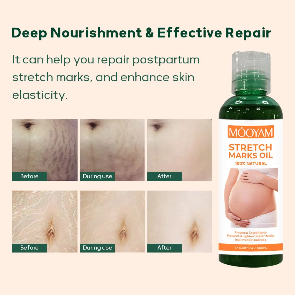 Strong Effective Stretch Mark Removal Oil Scar Remover Body Pregnancy