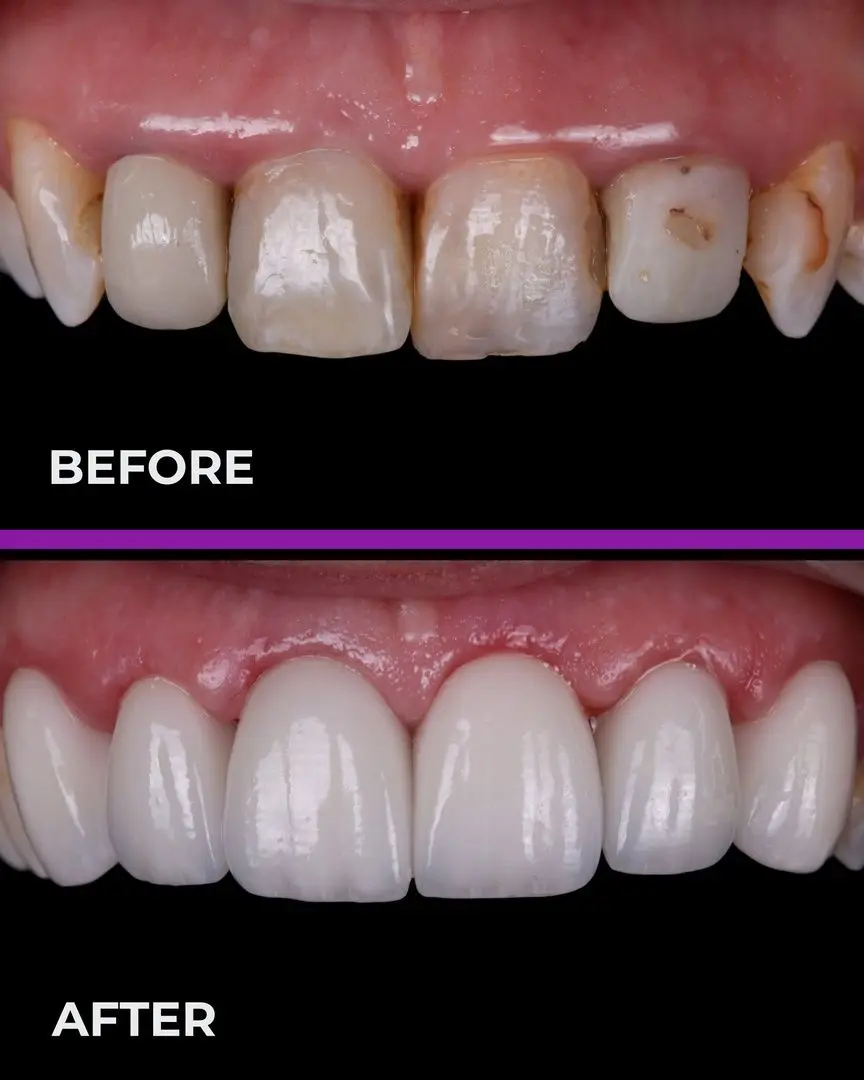 YUCERA 1200MPa 98 HT Dental Zirconia Blocks Dental Consumable Pre Shaded Zirconia Dental Zirconia Block