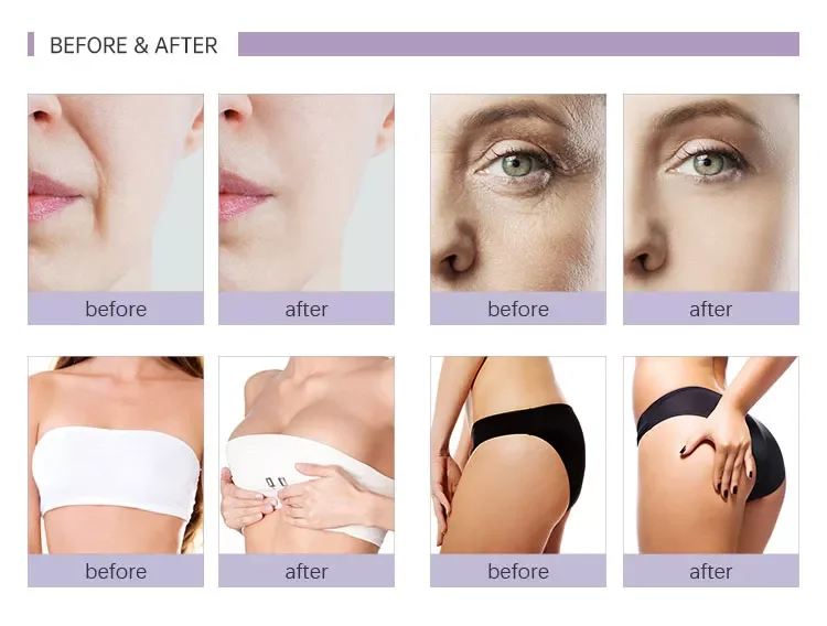 Hereme lips augmentation nose cheek HA gel injection cross-linked hyaluronic acid dermal filler for lip injections