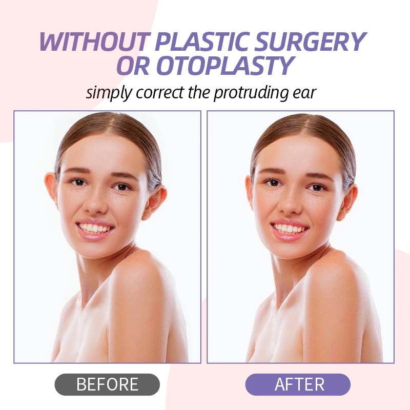Cosmetic Ear Corrector Protruding Solution to Otoplasty Surgery No More Big  Ears Sticking Out Ear Sticker