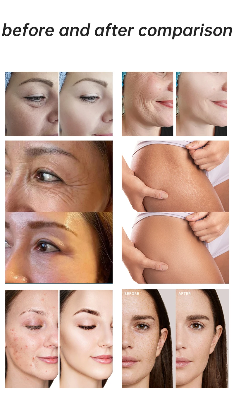 2025 Professional Portable Plasma Beauty Equipment ABS Standing for Legs/Arms US CN Skin Tightening Collagen Increase Wrinkle