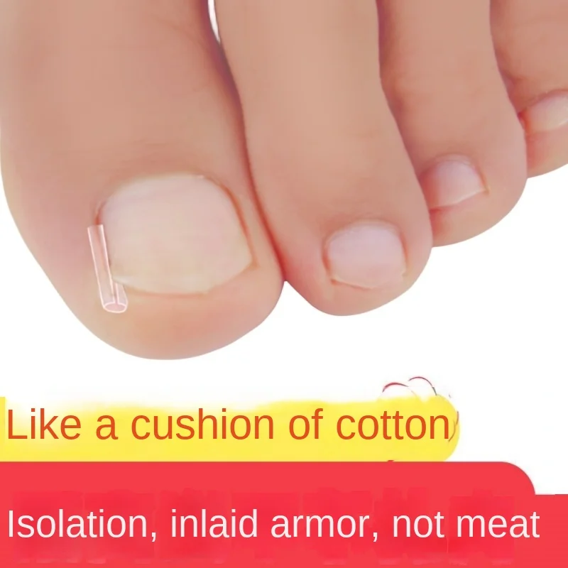 Indrown Nail Type C Pad Plastic Groove Spacer Straightener for Ingrown Nail Inflammation Filling Long Toenail Meat Paste