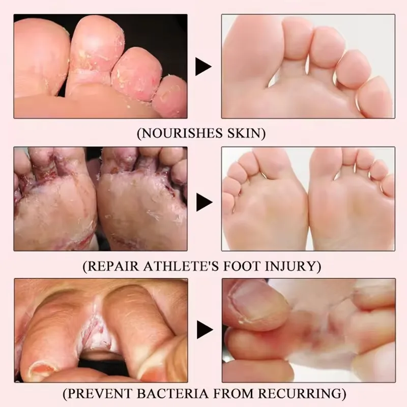 Bacterial Infection Fungus On Heels Of Feet 15g Foot Cream Anti