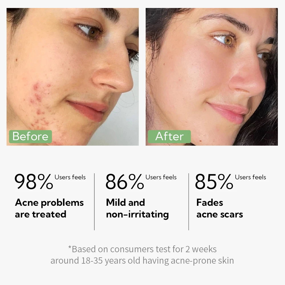Lanbena Hot Sales Pore Reducing Face Minimizing Face Serum Anti Acnes Cream details