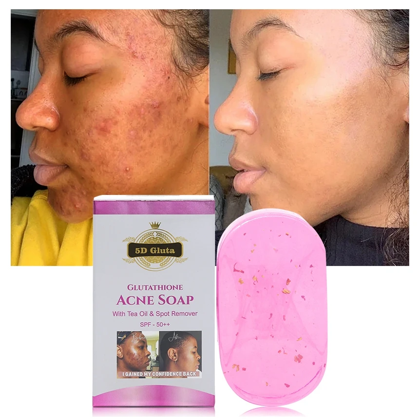 glutathione soap breakout Organic Tea Oil Glutathion Soap Face Anti Acne Dark Spots Remove Deep  Cleansing Glowing Natural Handmade Whitening Soap