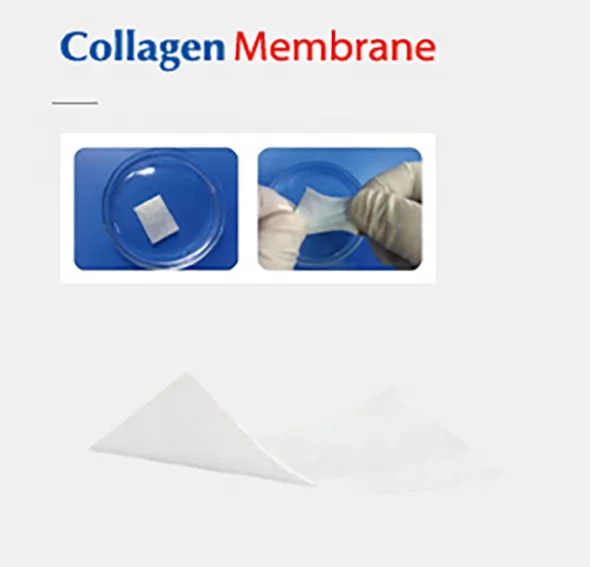 Dentium Membrana Ossium Absorbibilis Pro Grafting Ossium in Implantationibus Dentalibus Membrana Dentalis Originalis