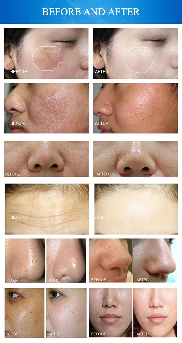 2023 Best 10 In 1 Multifunctional Dermabrasion Skin Care Beauty Machine Portatil High Quality Glowskin O+ Hydra Water Facial