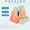 B dental implant yellow bottom black nail