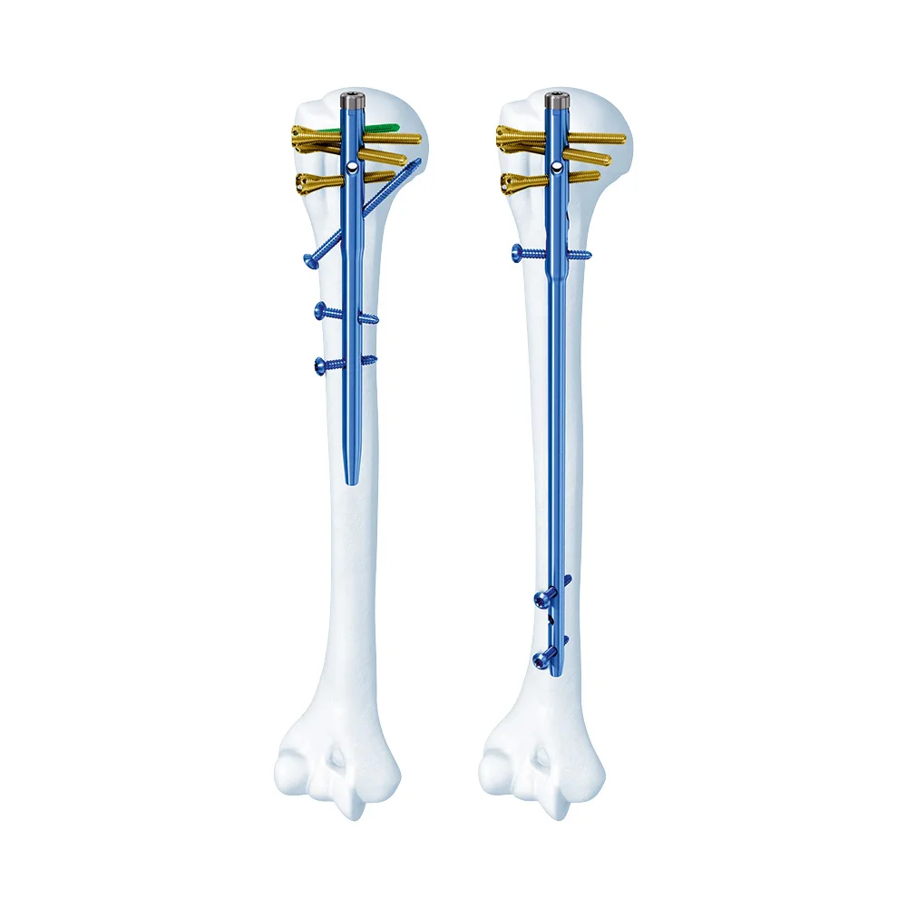 Humerus Nail