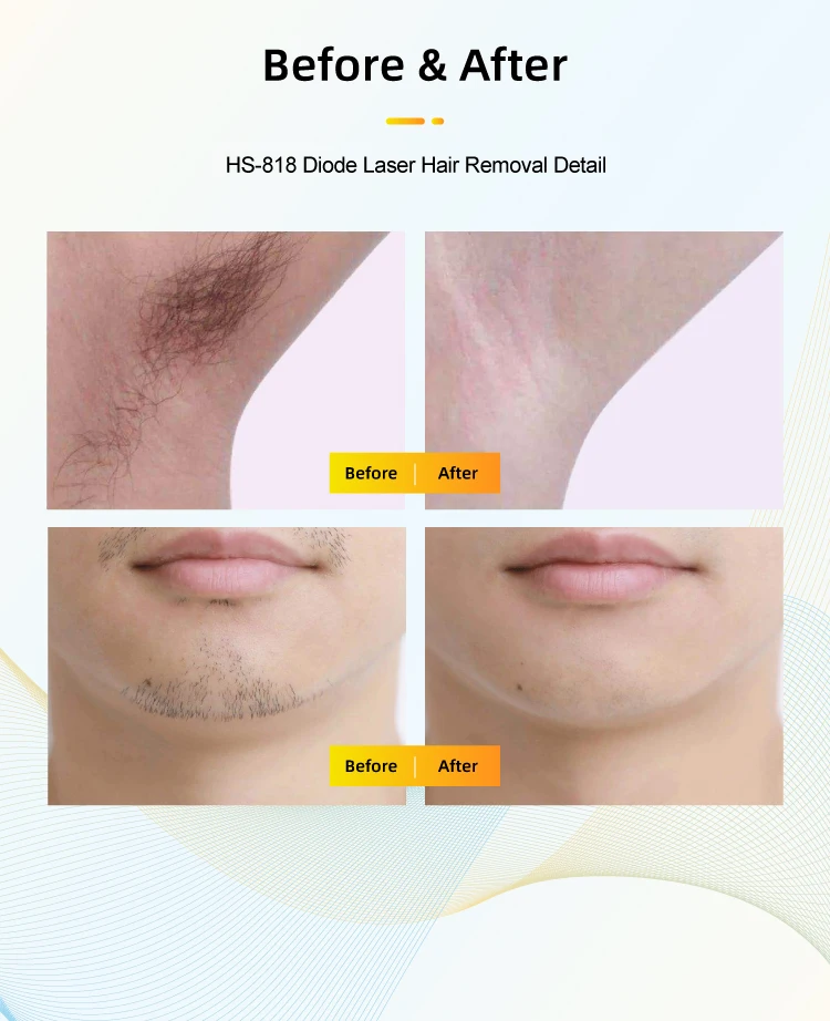 USA 510k Cleared Vertical 755 808 1064 Equipment Triple Wavelength Diode Laser Hair Removal manufacture