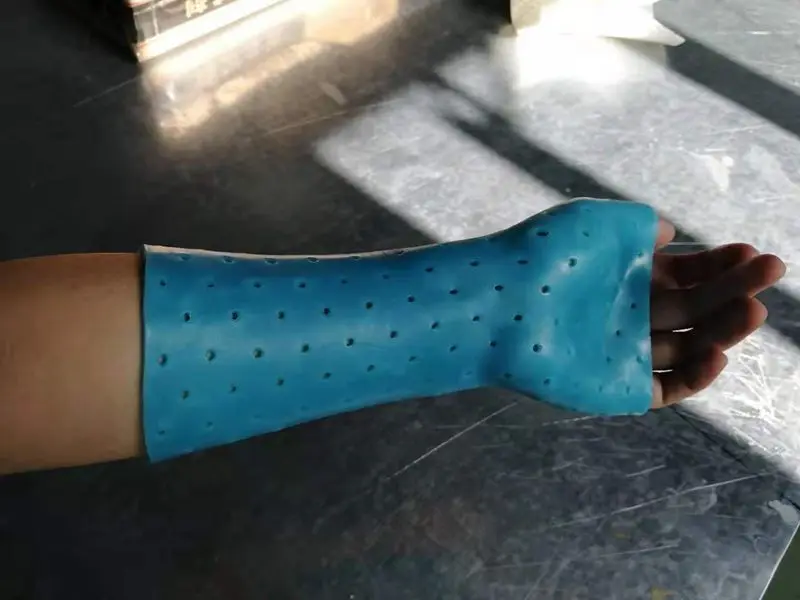 Splinting Material Thermoplastic Splint Lowtemperature Rehabilitation