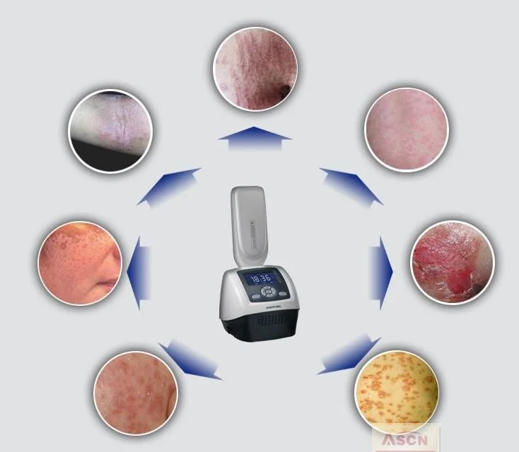 Kernel UV Light Therapy AC Power Supply 311nm UVB/PUVA Psoriasis Vitiligo Treatment UVB Phototherapy KN-4006BL