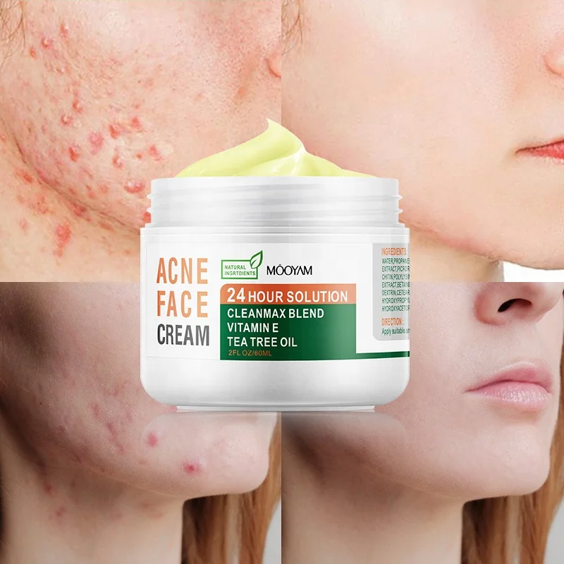 acne dark spots remover