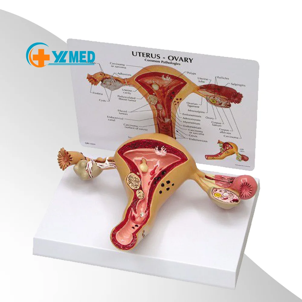 Factory Educational Equipment Female Human Anatomy Uterine Lesion Model PVC Anatomical Modelo