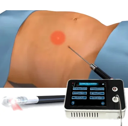 980nm Spider Vein Removal Machine - Laser Skin Tightening