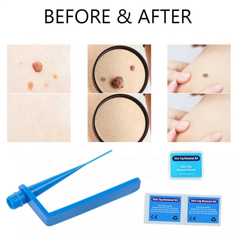 Home Use Low Price Skin Tag Remover Kit to Removal Skin Tags Body Effective Mole Wart Removing Skin Tags