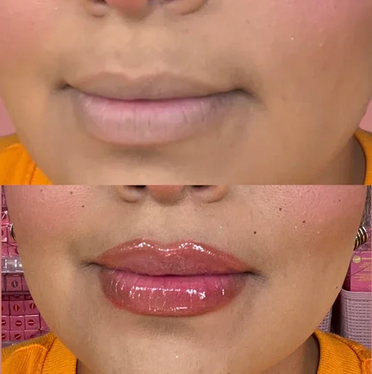vitamin c on lips before and after Lipo Mino Mix Vitamin Injection Framingham Benefits - DermalTouch main image 1