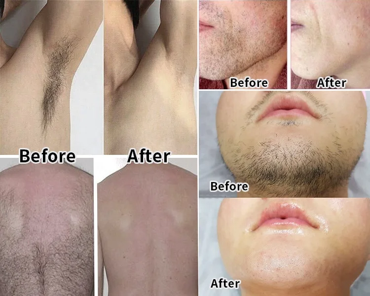 Piel Depilacion De Bigote Permanente Depilación Láser Como Depilar - Main Image