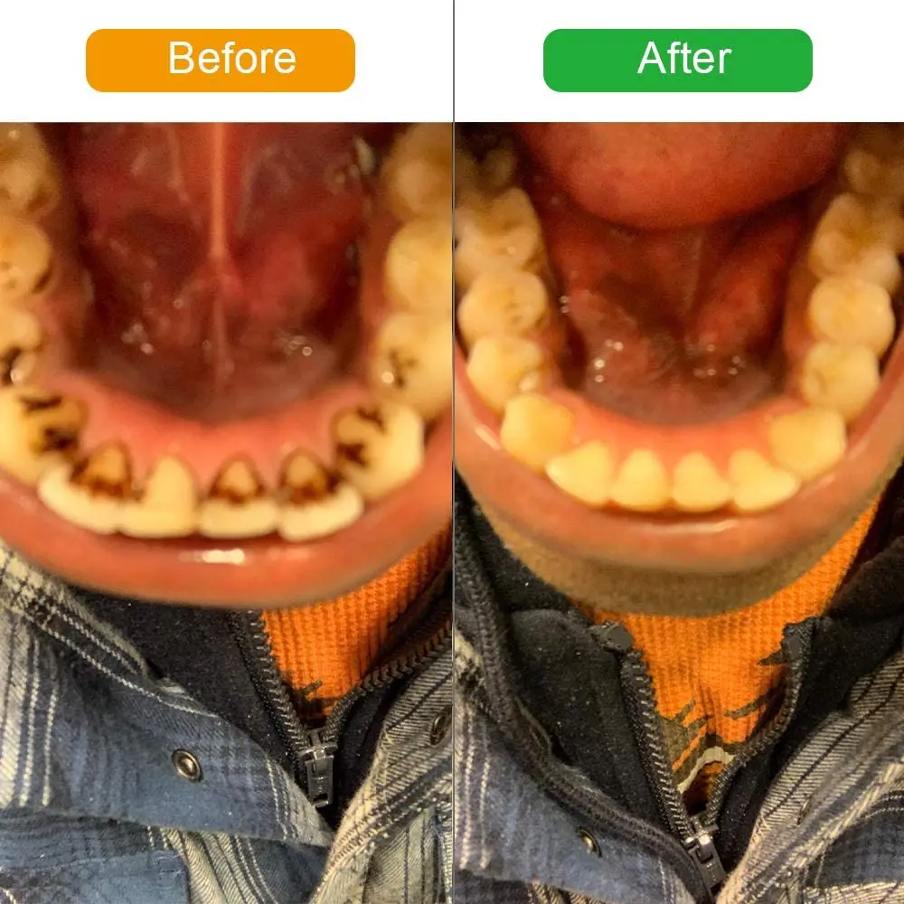 teeth cleaner (13)