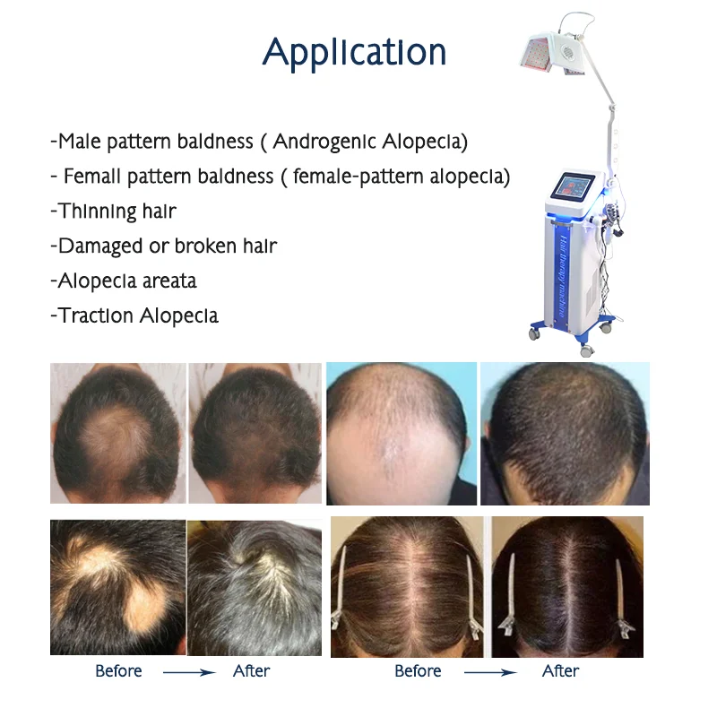 High-Efficiency Laser Beauty Machine for Hair Growth Treatment with Bio-Energy Low Level Laser Therapy Diode Laser 650nm