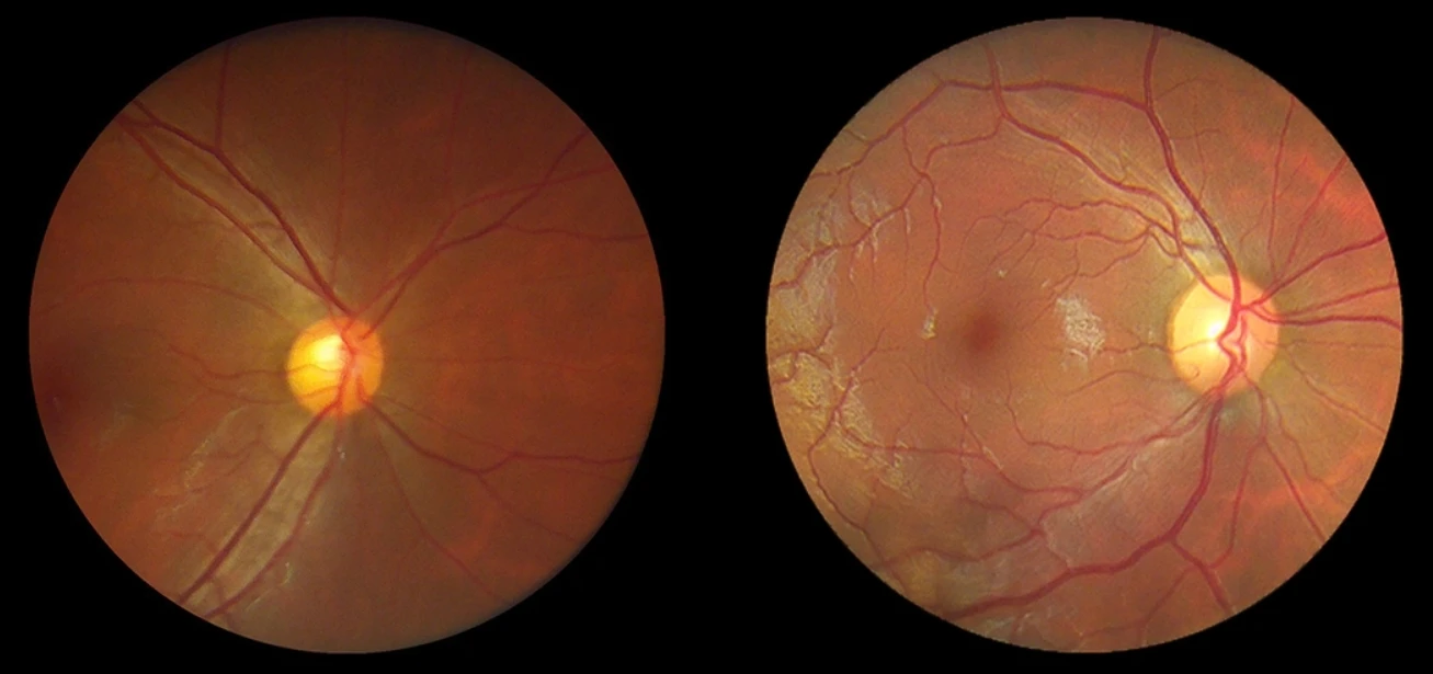 Portable Fundus Camera CFC-X Handheld Eye Fundus Retinal Camera Non-Mydriatic Digital Fundus Camera Ophthalmic Instrument
