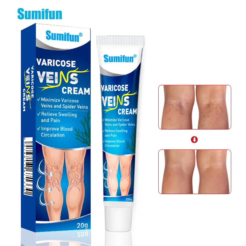 Sumifun Veins Ointmnet Vasculitis Varicose Veins Treatment Cream 20g ...