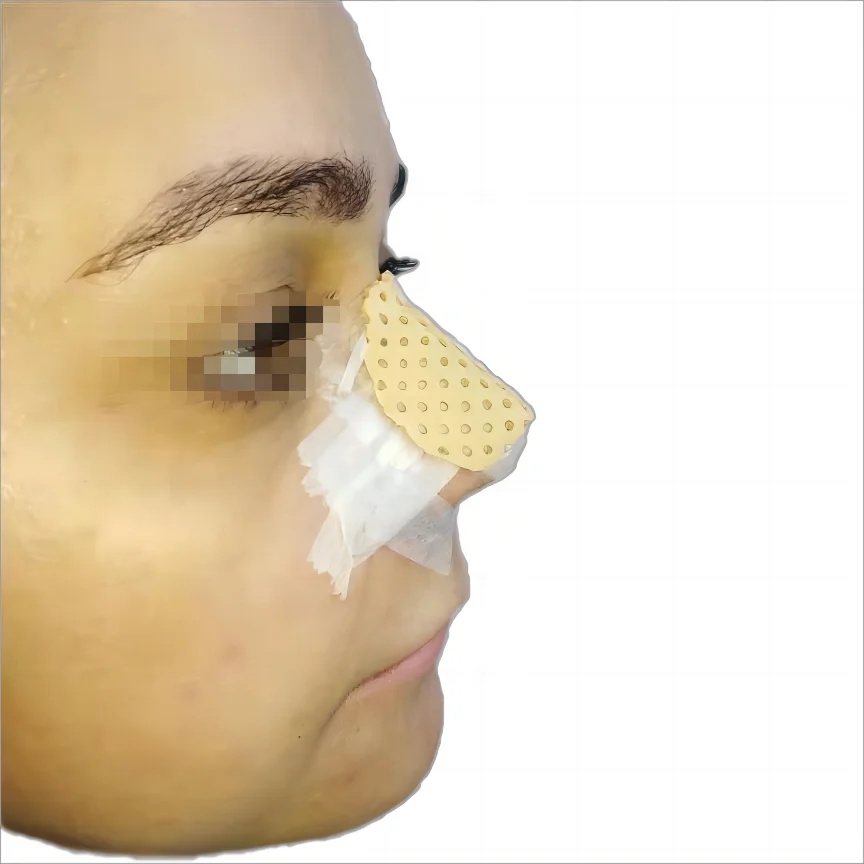 Nasal Fracture Splint Nasal Splint For Fracture External Nose Or