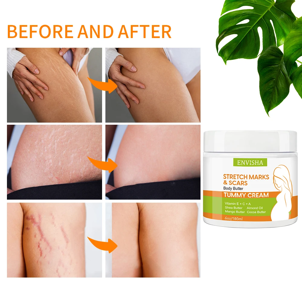Best Effective Stretch Mark and Scar Removal Cream After Pregnancy Treatment Stretch Marks Remover Cream for Female