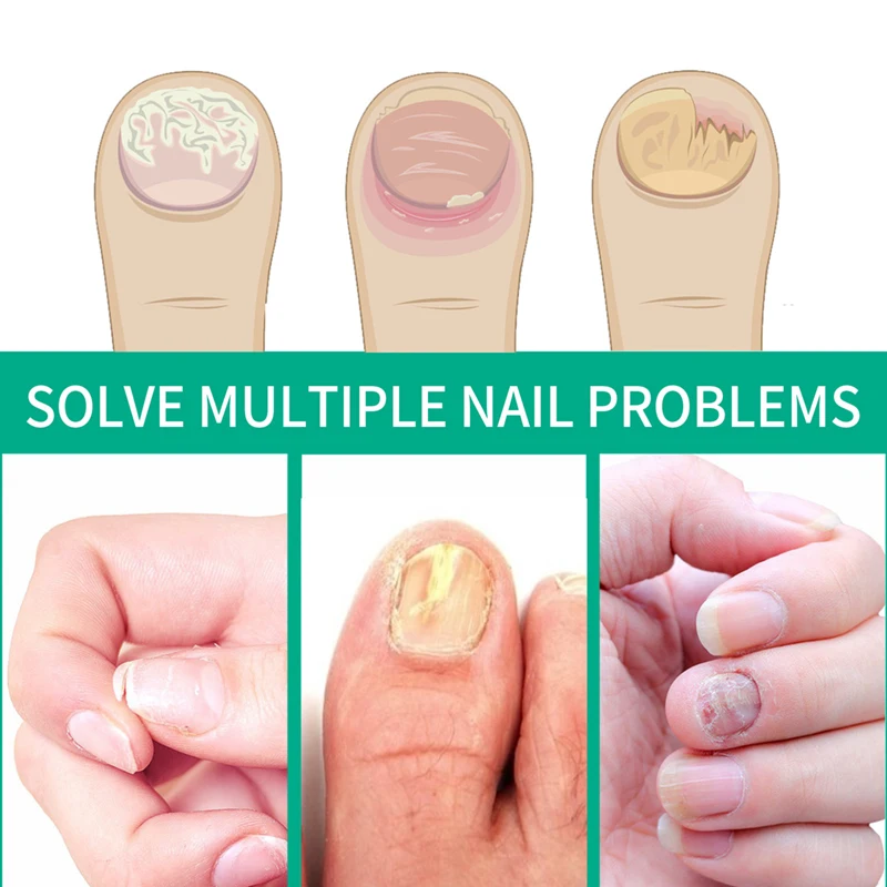 20g nail fungus ointment bacterial fungal relieving nail nourishing repair cream