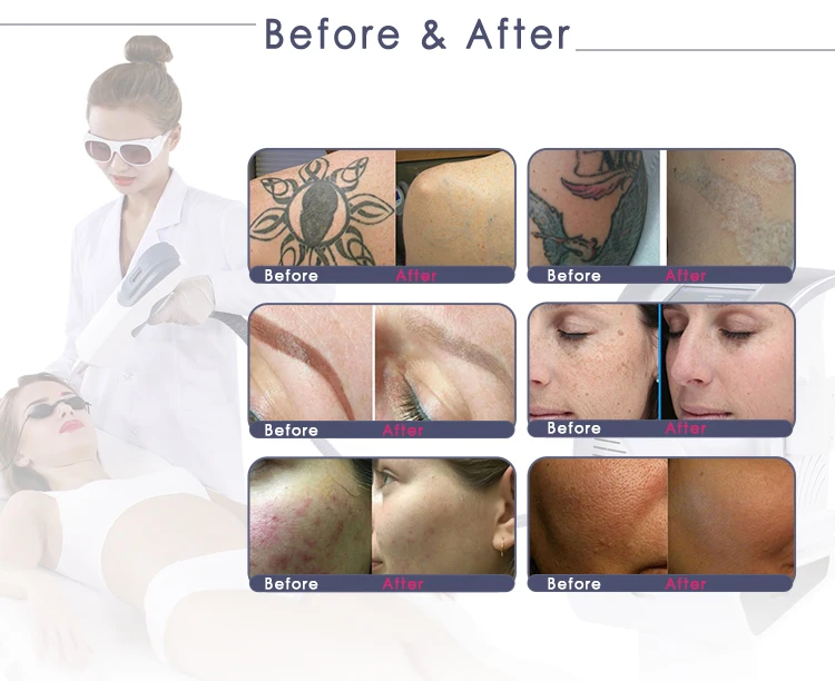 Professional Q Switched Nd Yag Laser eyebrow tattoo Removal