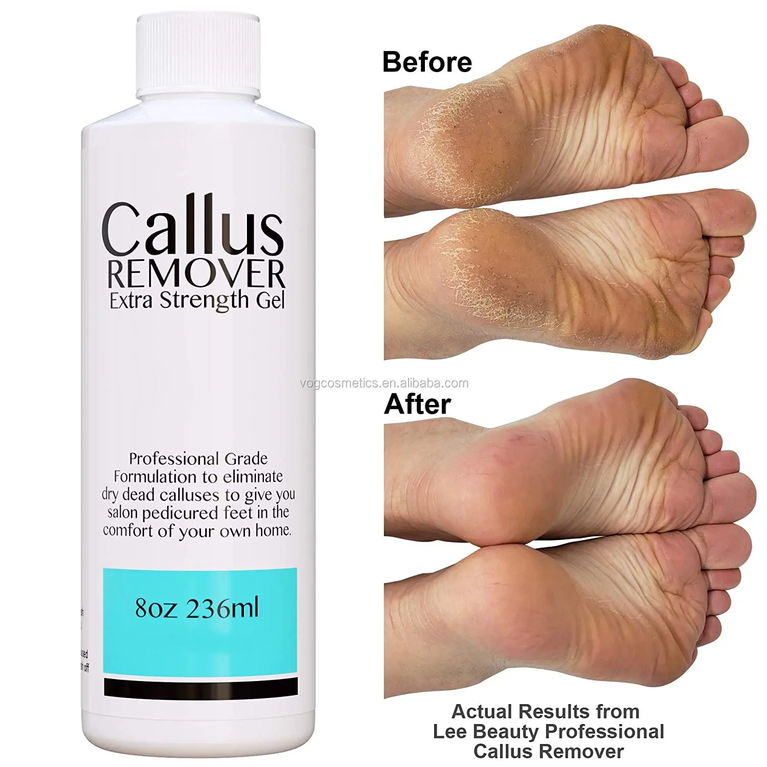 
OEM/ODM Feet Gel with Tea Tree Oil for Corn and Callus Moisturizes & Hydrates Toughened Skin Callus Remover Gel 
