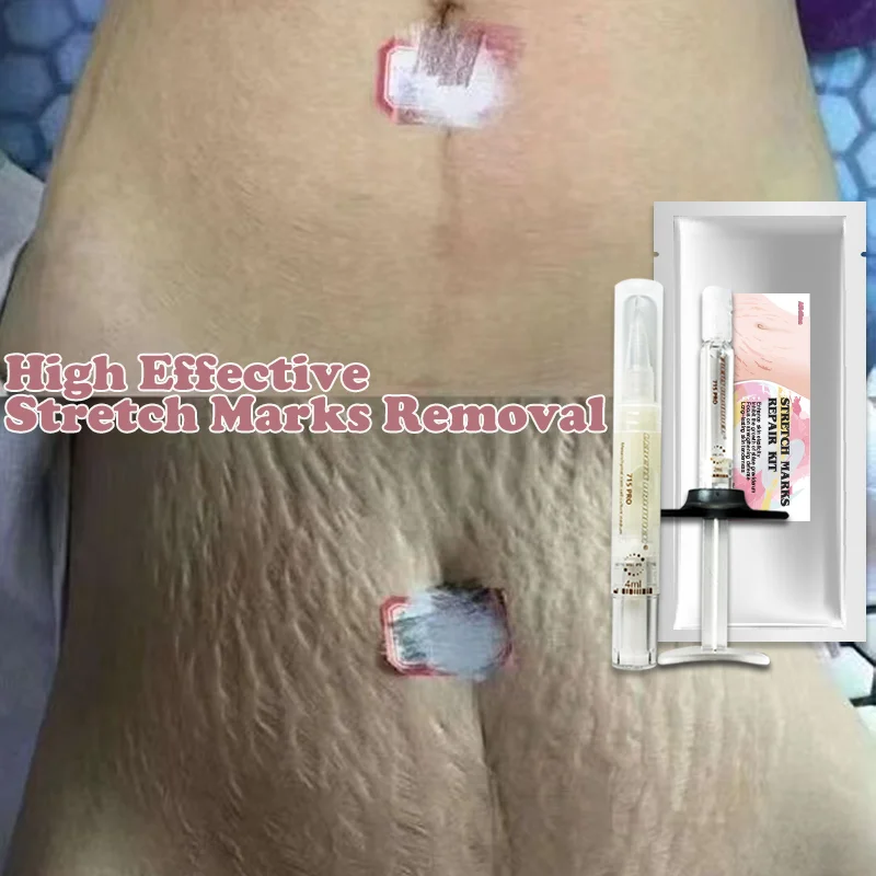 ZS EGF Infused Intensive Stretch Mark & Scar Cream for Postpartum EGF Stem  Cell Tummy Tuck Tightening Stretch Mark Removal Cream