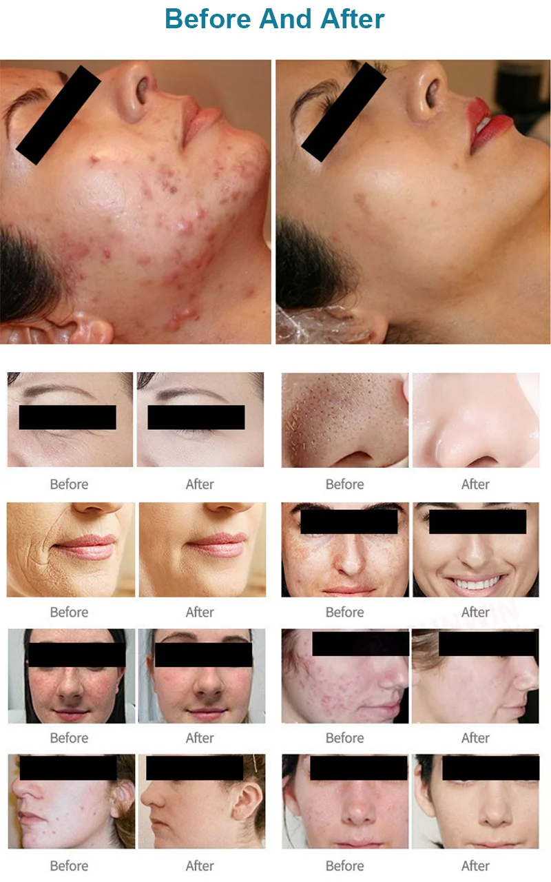 2024 portable hydra oxygen facial smart ice blue machine for facial treatment health canada approved microdermabrasion machine