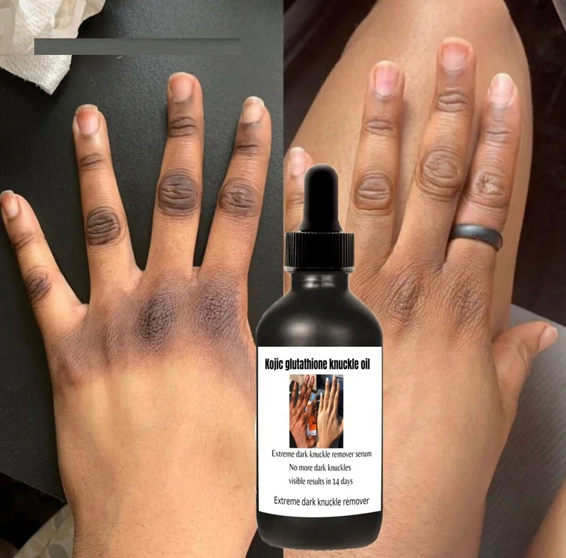 glutathione for dark knuckles Clear, even-toned hands and feet? YES PLEASE! Get the Cohaar Hands & Feet Whitening Combo featuring our top-rated Whitening Cream + Serum. Powered by Glutathione, Vitamin C, and Licorice This is an ideal solution