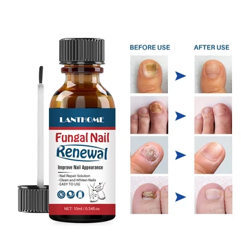 OEM Private Label Nail Strengthening Treatment Repair For Hand Foot Toe Nail Fungus Infection