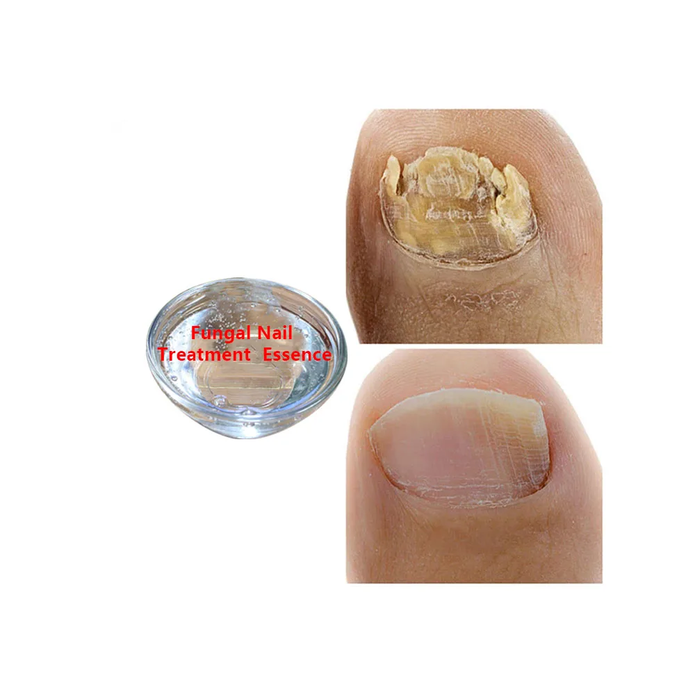 Nail Fungus Removal Cream Onychomycosis Fungal Nail Treatment