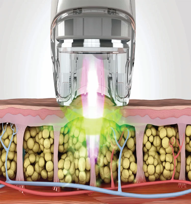 Body Contouring Slimming Machine 2020 Professional Fat Removal body shape Machine body shape Price Weight Loss