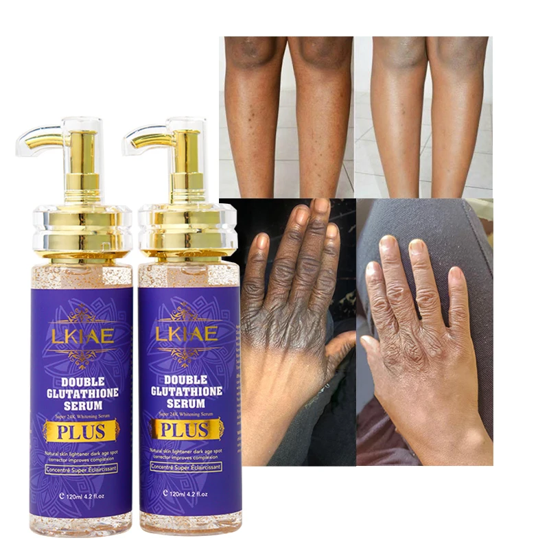 best glutathione serum for anti aging Hyperpigmentation Treatment with Glutathione main image 1
