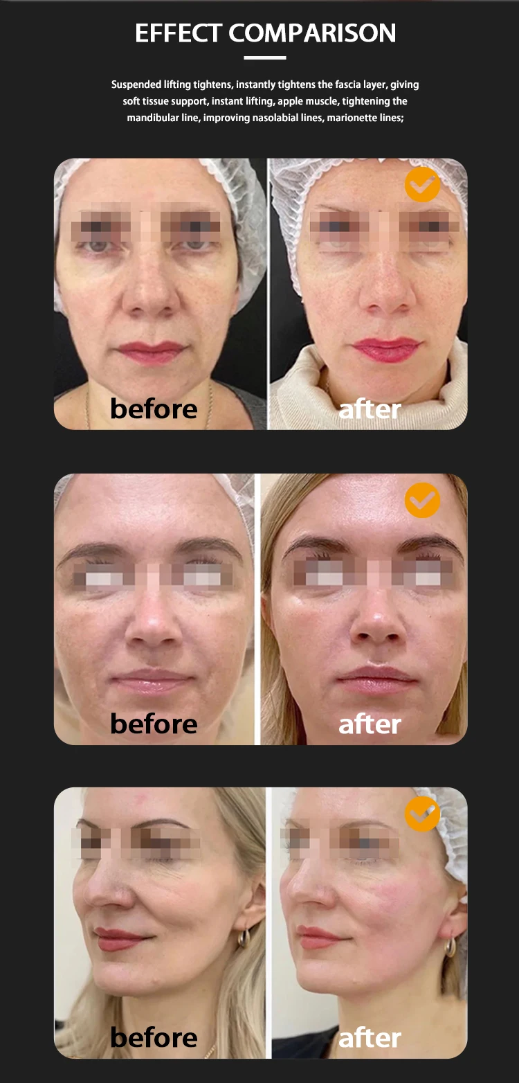 2023 New Model Gold TT 12 D Face Lift Machine 2 in 1 Rotating 360 12D Hifu Mmfu MPTSTL