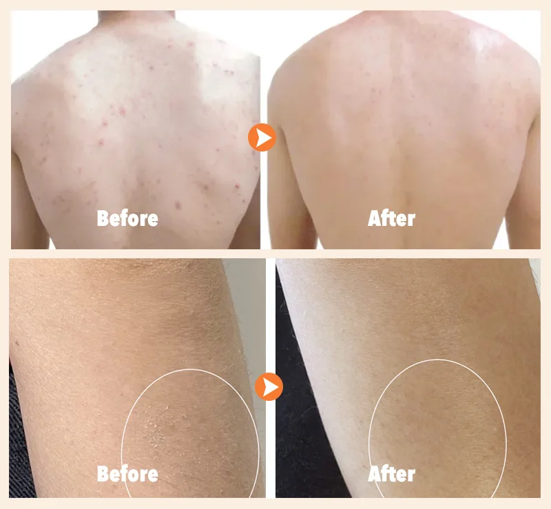 Bha Top Ranking Salicylic Glycolic Acid Skin Revive Exfoliating Body