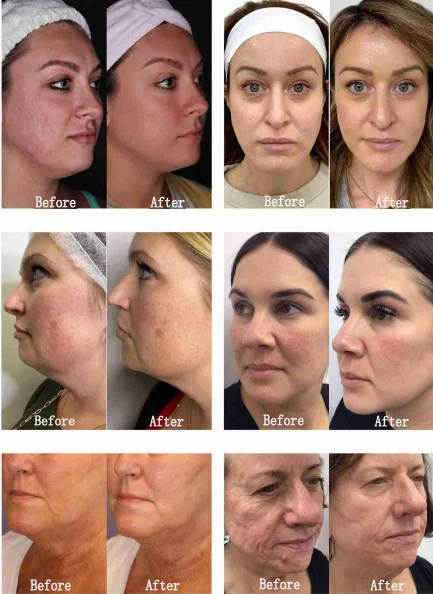 12D RF Frozen Hifu Machine for Wrinkle Removal Body Slimming