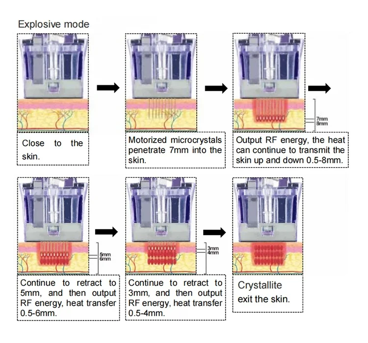 Discover a clinical-grade Microneedling RF System engineered for deep dermal remodeling, collagen stimulation, acne scar reduction, and skin tightening. Adjustable depth up to 7mm with precision RF delivery. Professional Fractional RF Microneedling Machine For Sale