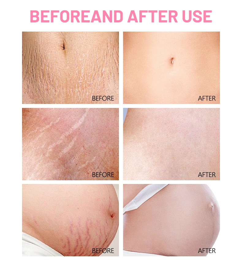Aichun Beauty Best Anti-Stretch Mark Body Oil Strech Marks Removed and Firming Essential Oil Preventing Reducing Stretch Marks