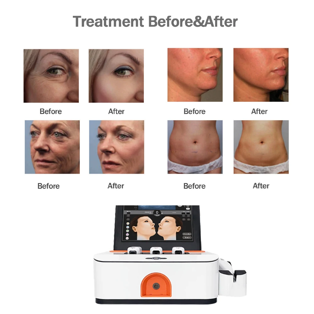 Portable Home 4D HIFU Machine Face Lift and Vaginal Tightening Wrinkle Remover Face Tightening Slim Device