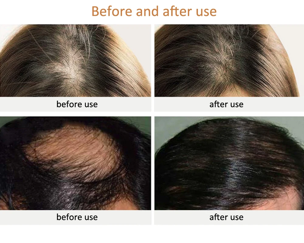 Blue/red Light Hair Growth Led Hair Cap 470nm 630nm 650nm Led Light