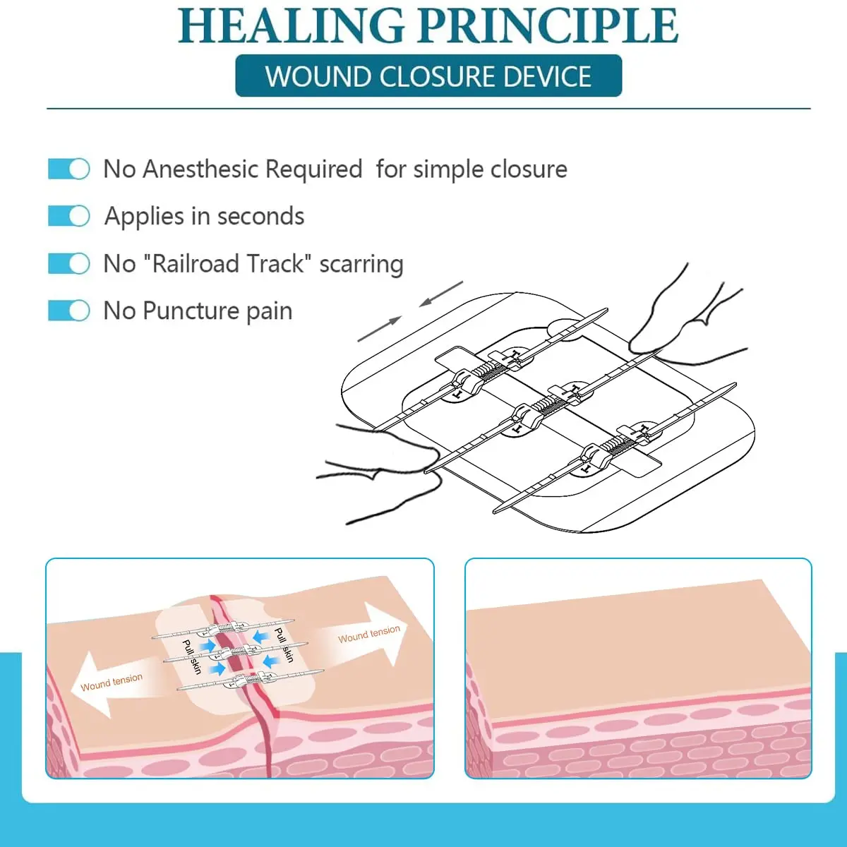 Trummed First Aid Suture Free Zip Lock Stitches Medical Zip Stitch